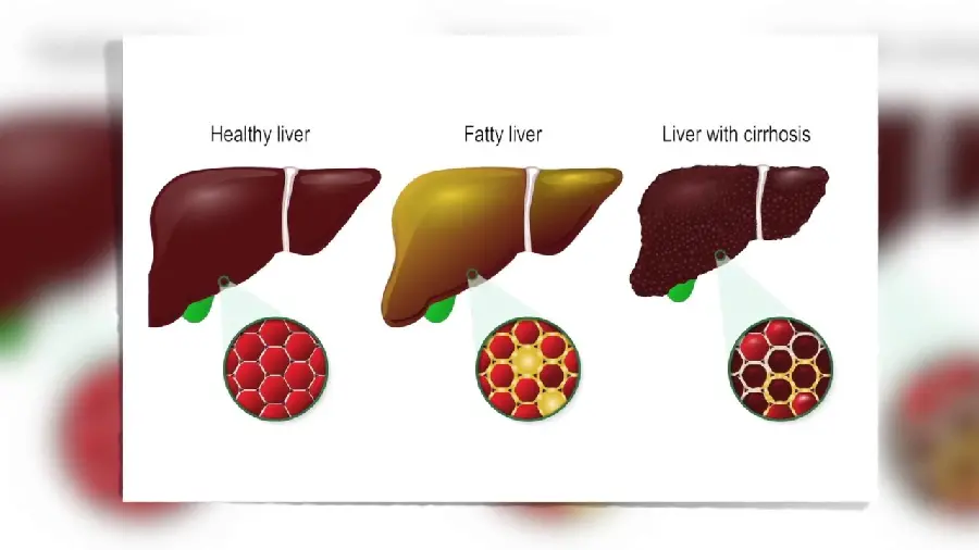 عکس مقایسه کبد سالم با کبد چرب