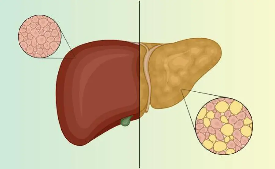 عکس کبد سالم و کنار کبد چرب